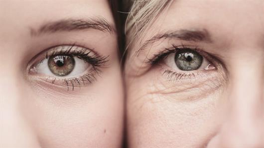 Addressing dark eye circles with fillers