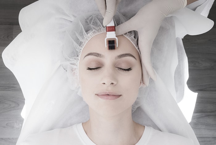 Microneedling: how to prepare for the treatment (and prices)