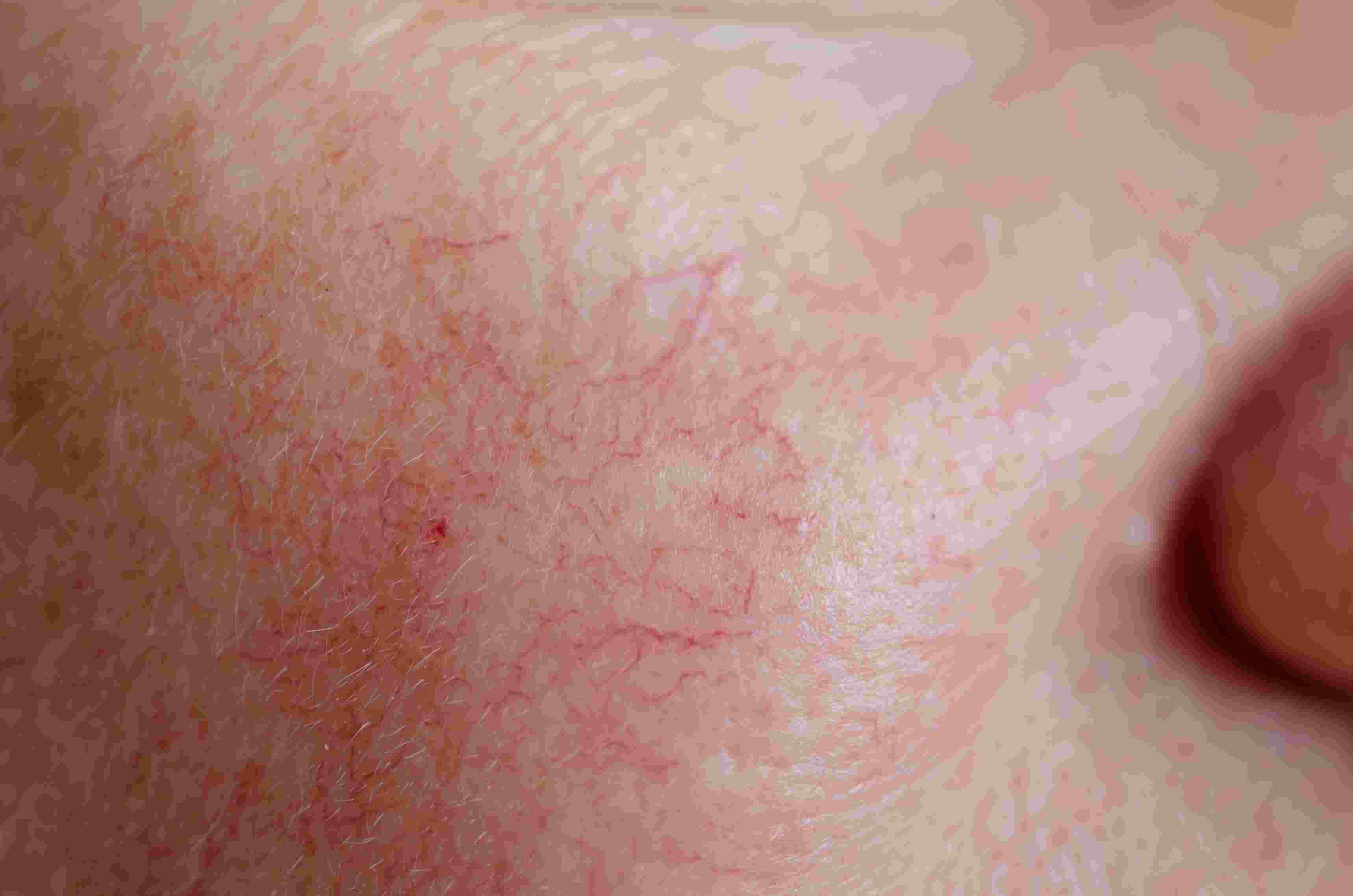 Dilated capillaries-min.jpg